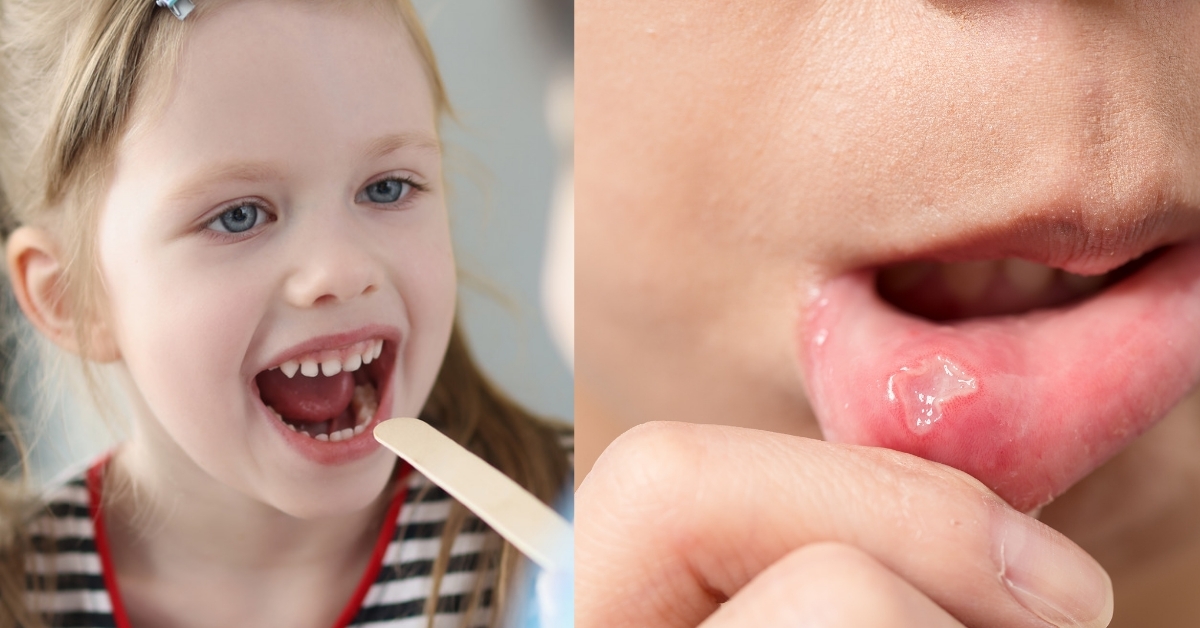 Cold Sores vs Canker Sores: What's the difference